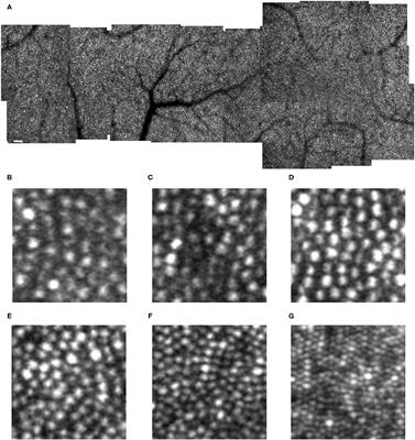 Cone Photoreceptors in Diabetic Patients